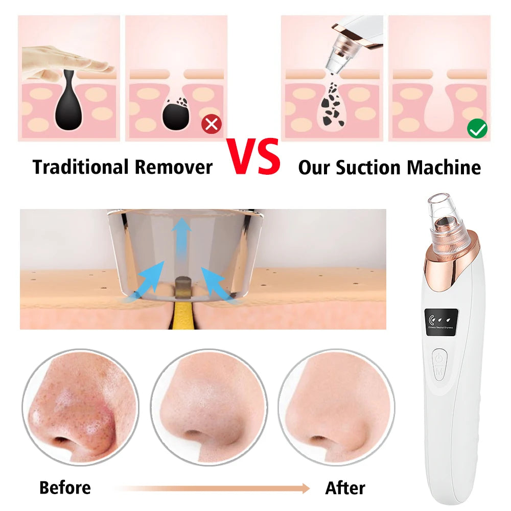 Deep Pore Cleaning With Powerful Vacuum Suction Removes Blackheads, Acne & Excess Facial Oil Easily Rechargeable & Portable Design For Everyday Skin Care